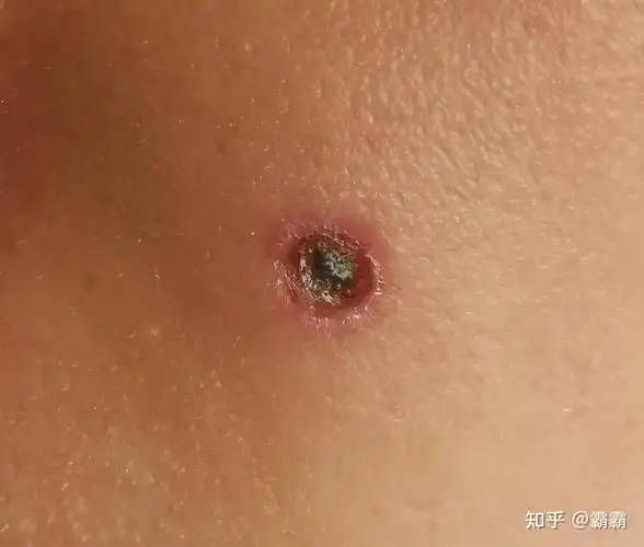 药水点痦子,恢复日记,供大家参考