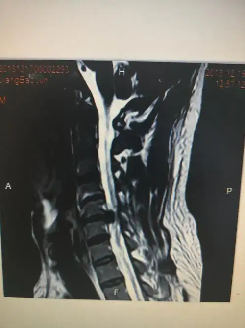 ct检查等)证实为颈椎病,那应尽快手术