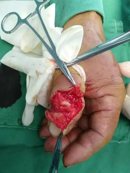 拇指长伸指肌腱断裂