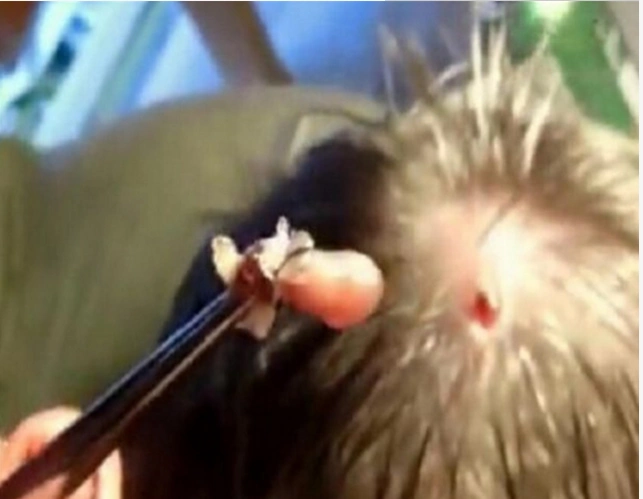 惊:活人脑袋里长虫子,医生果断切开后拿出!