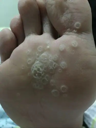 跖疣的最佳治疗方法不影响生活慎点
