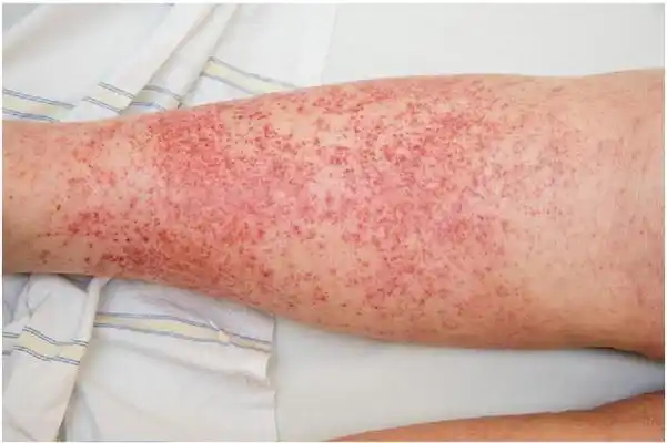 图文盘点肢端分布的血管性皮肤病