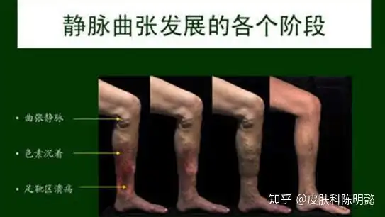 早期呈网状静脉伴毛细血管扩张,后逐渐形成迂曲的"蚯蚓样"曲张静脉,伴