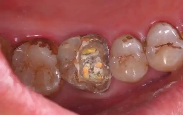 右上六根管治疗