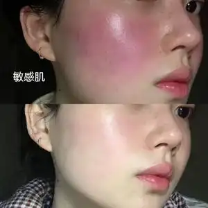 敏感肌肤专用面霜红血丝泛红皮肤修复角质层男女脸部增厚护肤品去