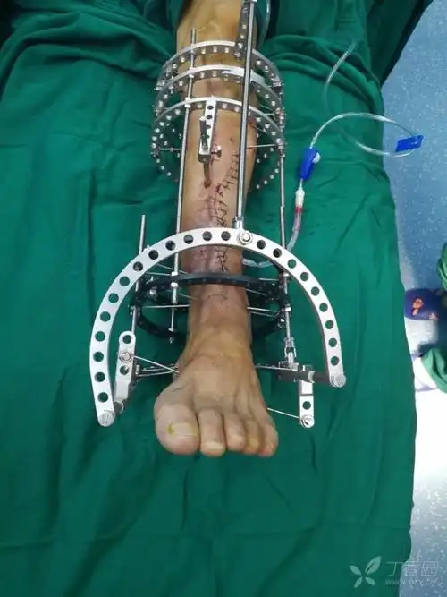 骨科管式外固定架_器械百科