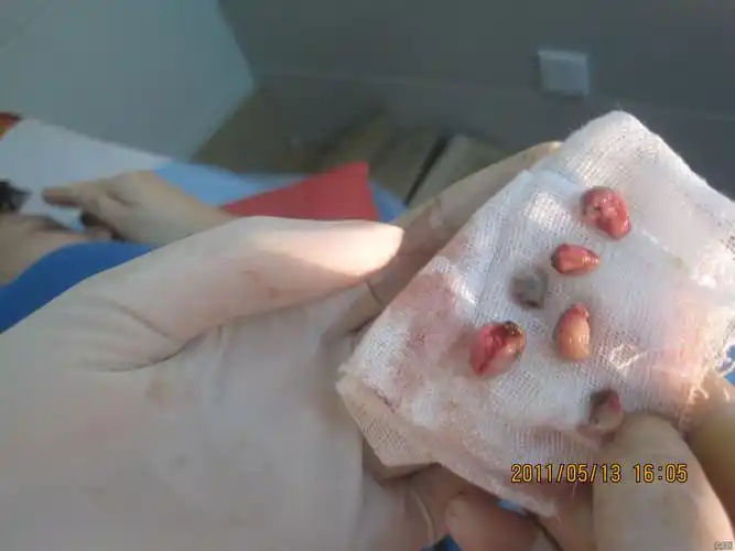 环状静脉曲张性混合痔术前术后第五例 - 肛肠外科讨论版 - 爱爱医医学