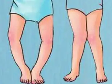 o形腿 内八字.jpeg