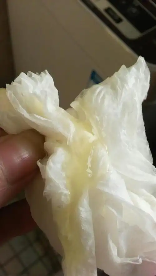 最近两天睡觉尿频厉害,坐起来就有控制不洗液体流出,但是去医院检查