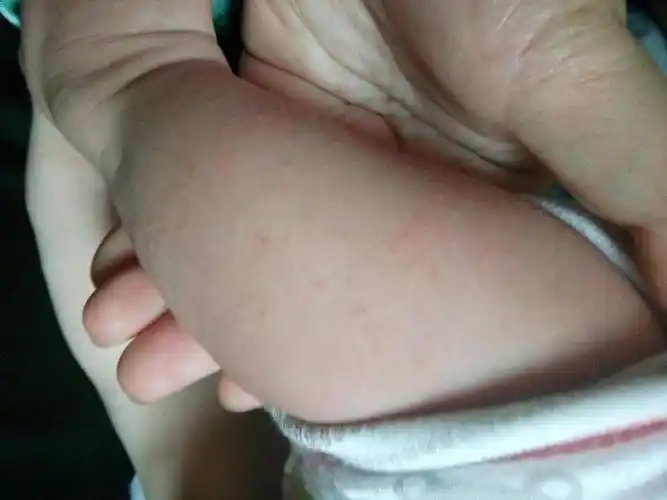 宝宝腿上想满了这种小豆豆是怎么回事啊