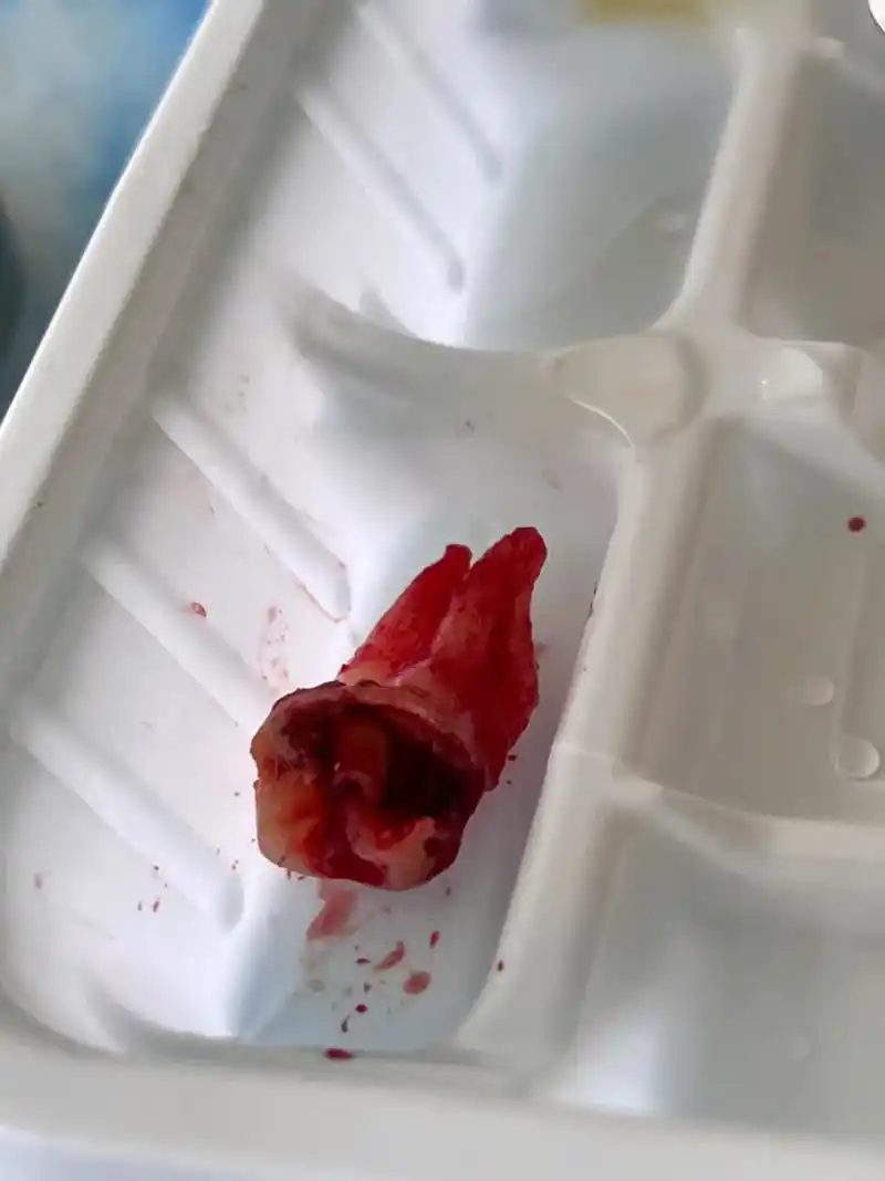 拔一颗尽头牙虫牙,用光了我一年的勇气!