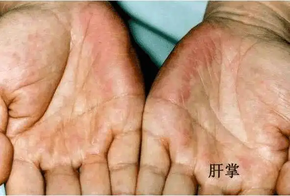 肝癌晚期身体会出现这些症状千万别拖了