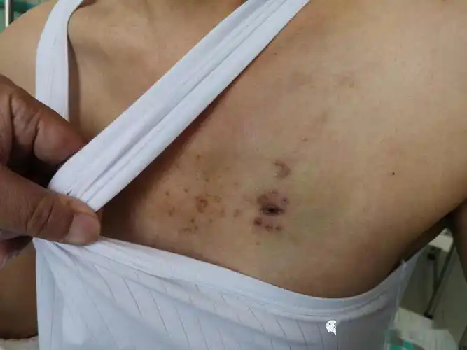 西吉县人民医院成功救治一名车祸致全身8处粉碎性骨折危重患者