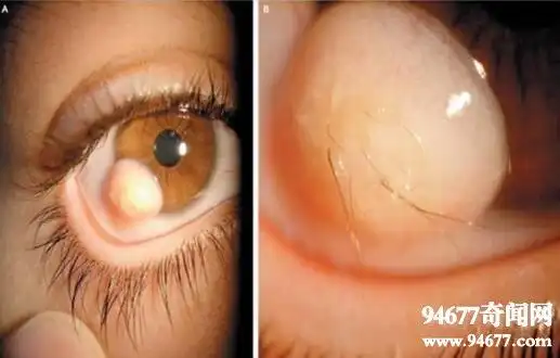 世界十大恐怖眼球,双瞳孔纹身眼让人无法直视(图片)