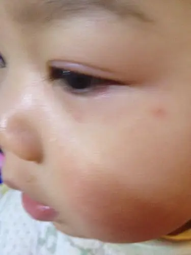 孩子眼下皮红并在眼周起红疙瘩,怎么回事?