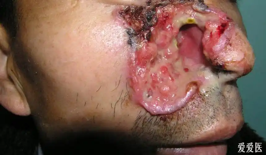 颌面部感染 - 口腔医学专业讨论版 - 爱爱医医学论坛