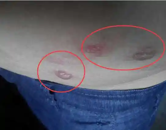 蛇盘疮你知道是什么吗老中医的这招祖传偏方能治