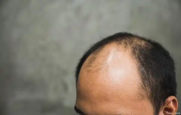 顾名思义,是指男性头顶中央逐渐稀疏,两侧头发密集,形似地中海的发型