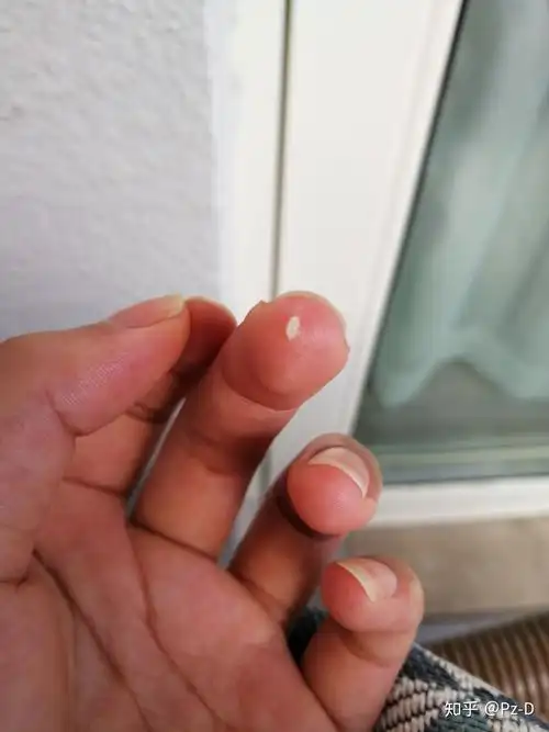 眼结石有多可怕!个人眼结石治疗过程分享记录