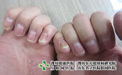 牛皮肤癣指甲空了怎么办及症状图片_青岛牛皮癣医院