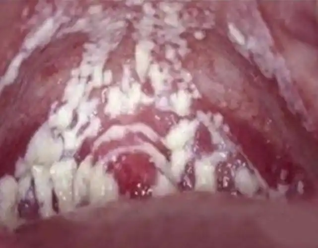 妇科疾病霉菌阴道炎图片_有来医生