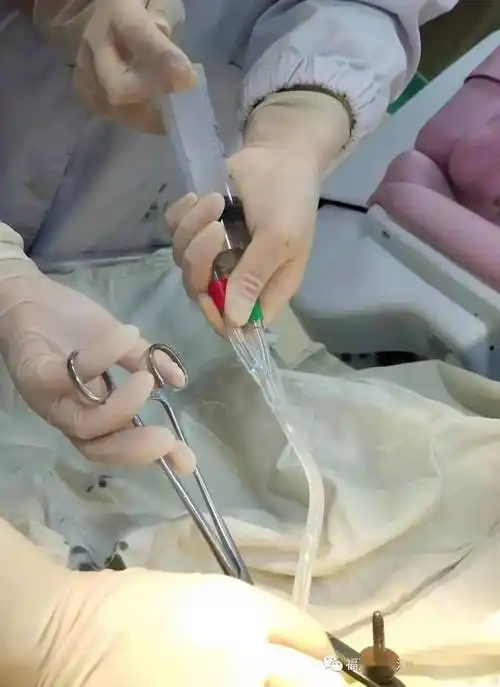 长汀妇幼首例水囊引产圆满成功