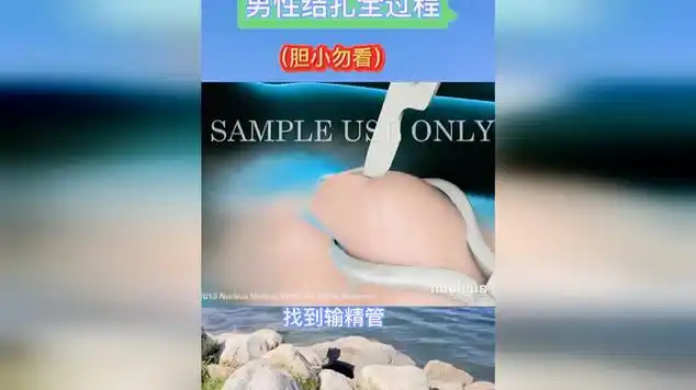 男性结扎全过程