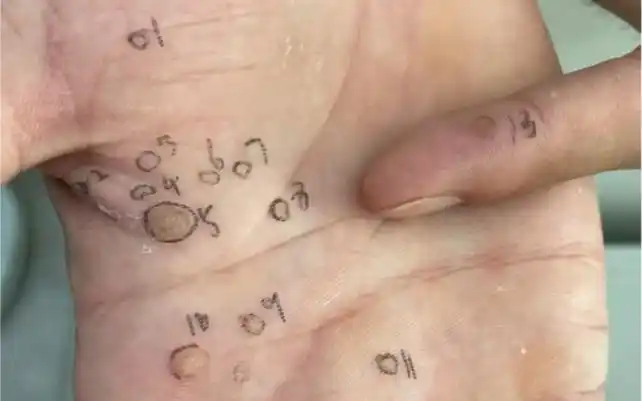 又是满手小疣疣