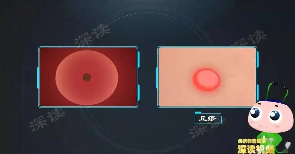 私处反复疱疹溃烂解密生殖器疱疹症状背后的真实原因超赞