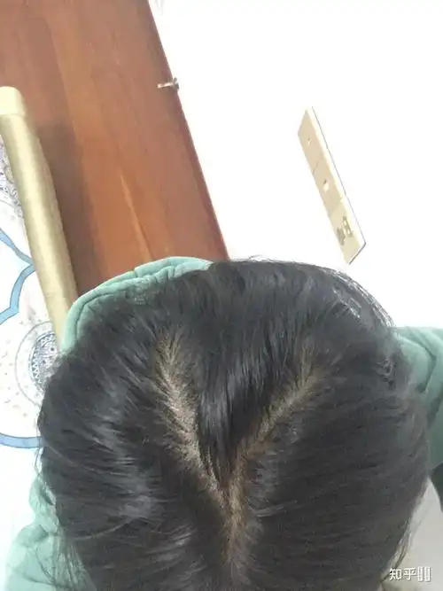本来后脑勺上有两个旋,加上头发不多,就像个字母y,平时根本不敢披着