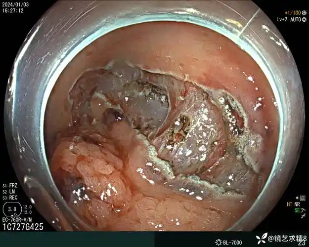 直肠巨大管状绒毛状腺瘤1例