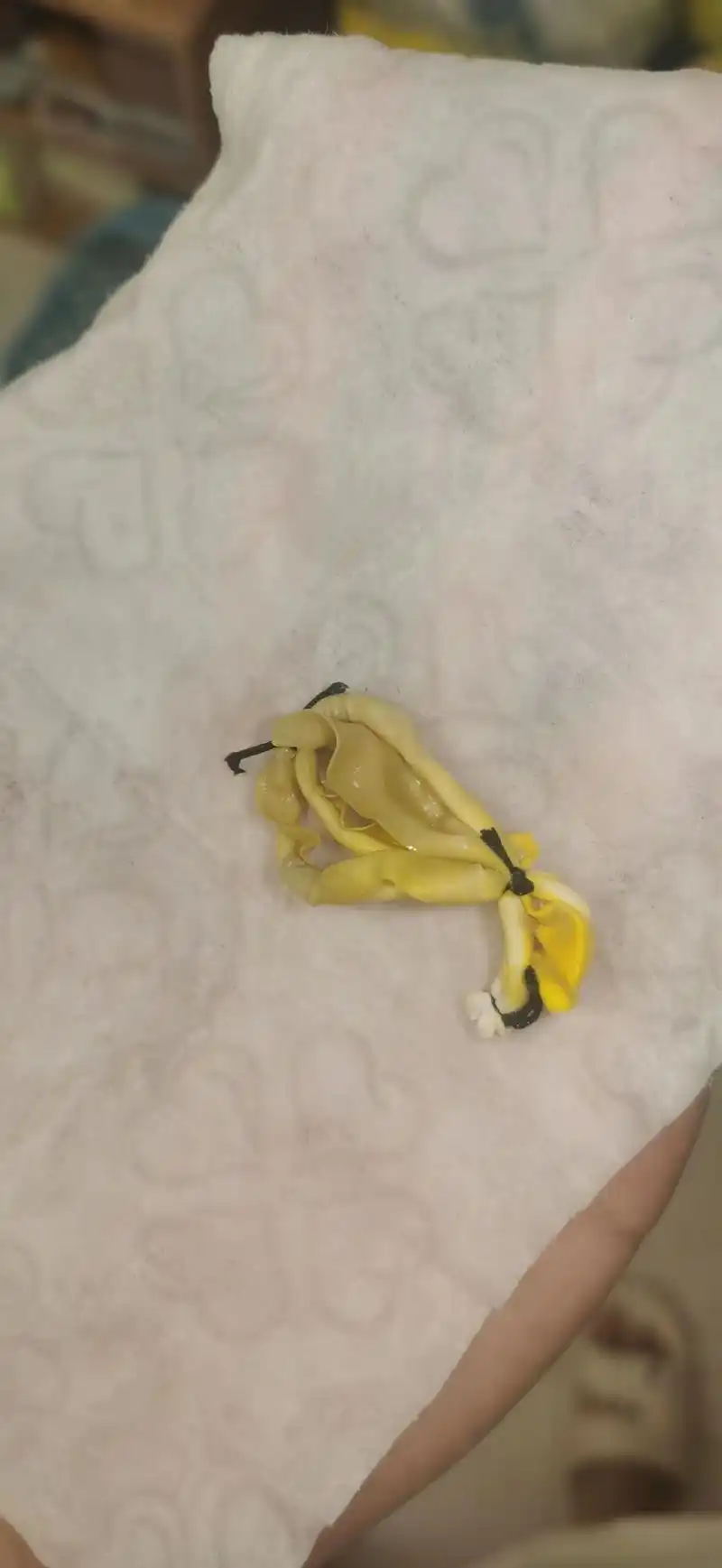 术后整整一周,这个皮筋终于掉了,期待上岸#肛周脓肿 #肛肠科 - 抖音