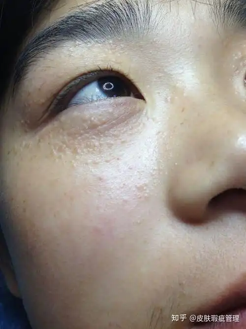 中西医解析汗管瘤的病因