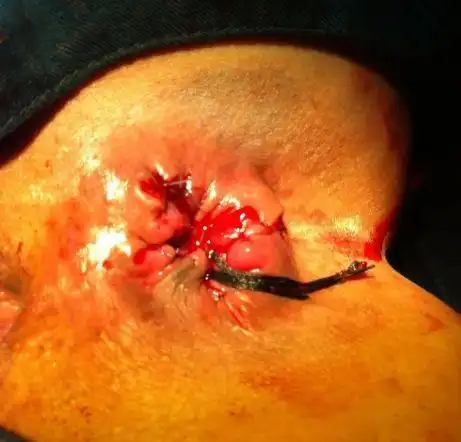 初期内痔的症状图片_有来医生