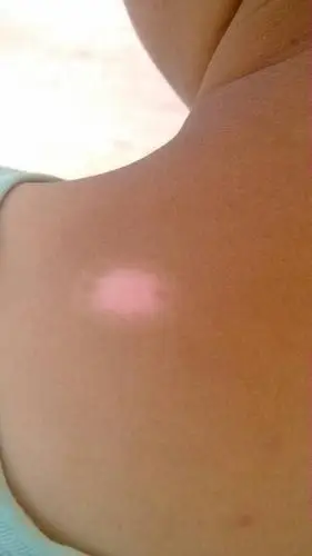 问:孩子后背上长的 貌似白癜风 但是一年了也没印到其他地方 哪位大神