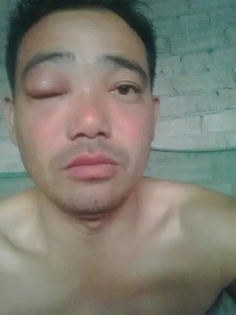 眼肿这么厉害,怎么办