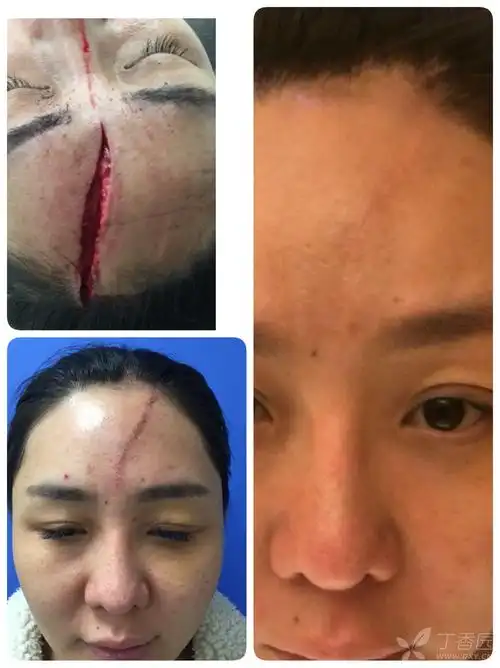 【讨论】外伤急诊缝合