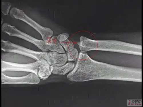 病例讨论成人青枝骨折