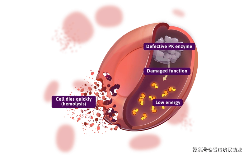 3期activate显示pyrukyndmitapivat对丙酮酸激酶缺乏症的益处