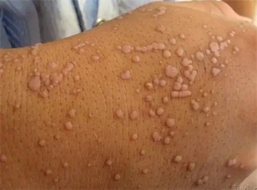 丝状疣的对比图片