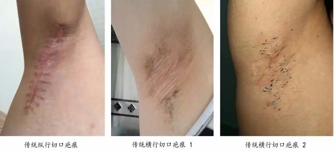 图解腋臭微创抽吸:今年夏天,用4毫米的切口对大汗腺来个大扫除_腋臭