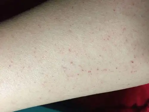 手臂小出血点_皮下出血点_医疗健康_医疗健康其他吃药一周后的情况,都