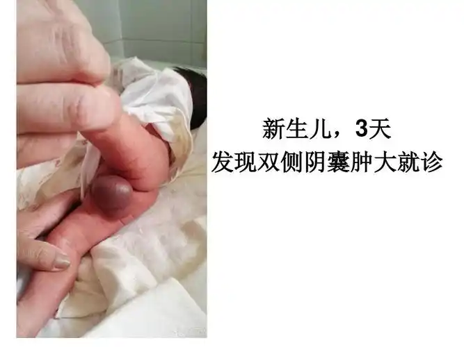 鞘膜外型睾丸扭转.ppt