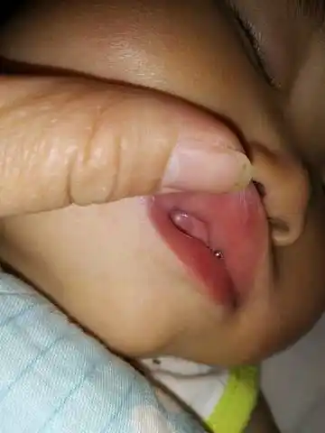 宝宝牙龈上有个小白点如图这是什麼