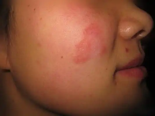 脸上长癣图片 (14)_有来医生