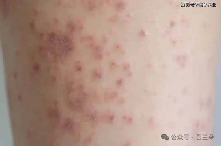 3种皮肤病又红又痒,千万别抓!