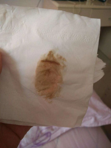 原创分泌物成为伤胎凶手众多孕妇胎停被影响准妈妈要警惕