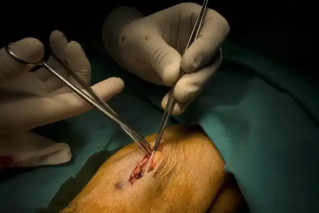 造口手术不久后原来鼓出来的一个包叫造口疝