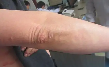 银屑病关节炎初期症状图片早期能治好吗