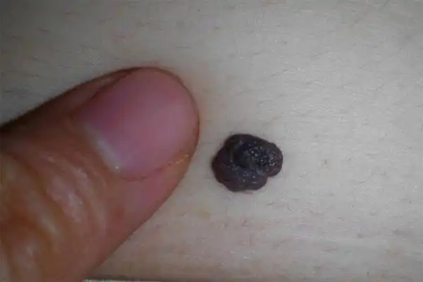 身上的痣可能是黑色素瘤?掌握4个区分法,或能预防肿瘤